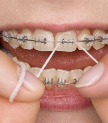 Closeup of a patient flossing between braces in Wellesley  