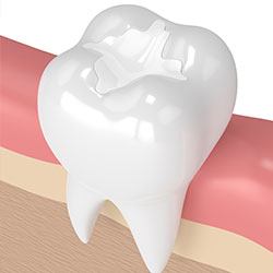 Animated tooth with tooth colored dental filling