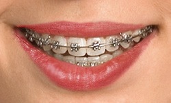 Smile with self-ligating braces