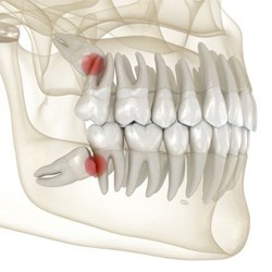Illustration of human jaw with impacted wisdom teeth