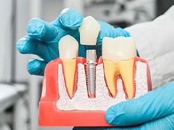 Dentist using model to demonstrate single-tooth replacement with a dental implant