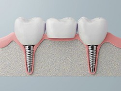 Illustration of three-unit dental implant bridge