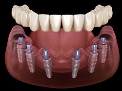 Illustration of an implant denture against dark background