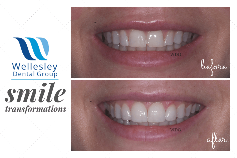 Smile with damaged top front teeth before and flawless smile after dental treatment