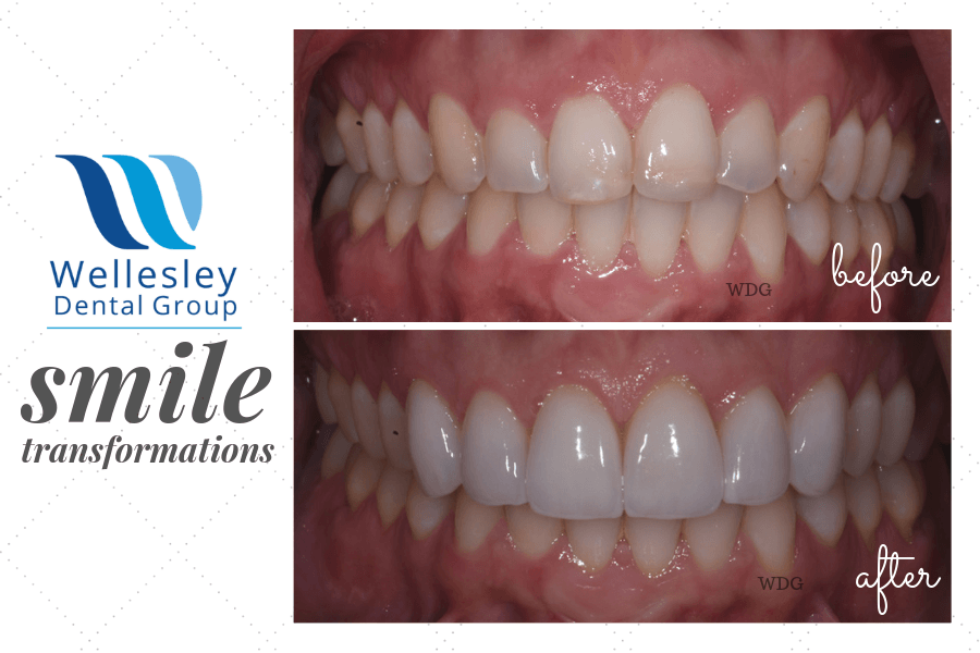 Smile before and after teeth whitening