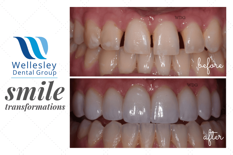 Smile before and after treatment to close gaps between teeth