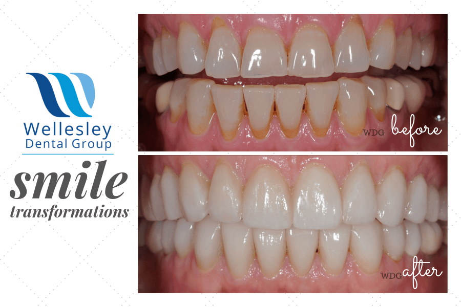 Smile before and after orthodontic treatment to close bite