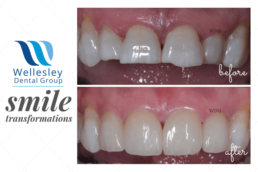 Smile before and after treating worn and damaged teeth