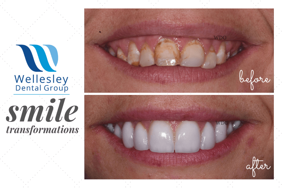 Severely yellowed and decayed smile before and flawless smile after dental treatment