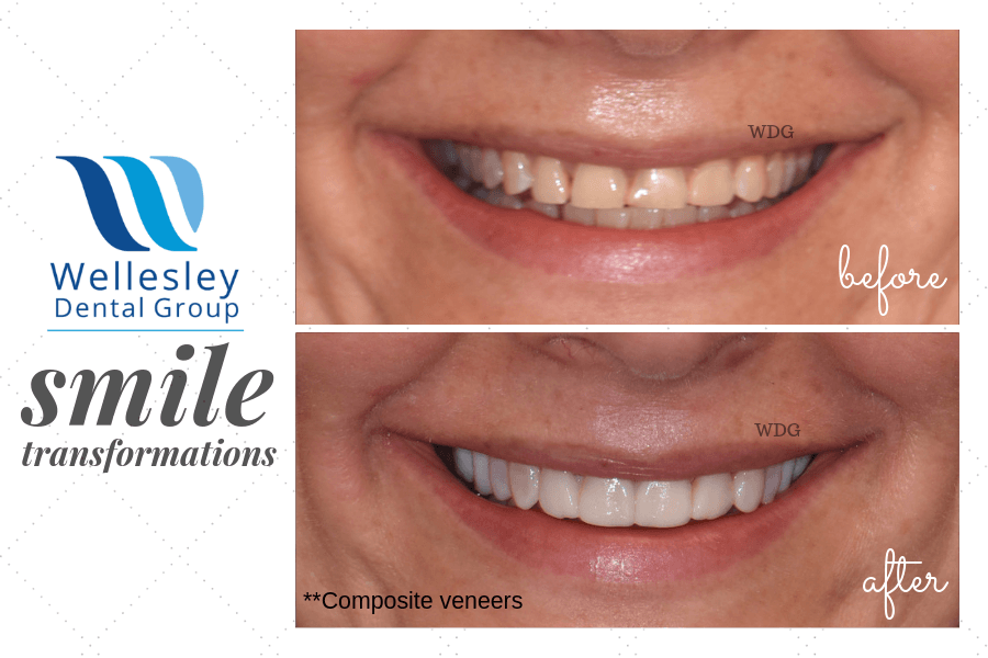 Smile before and after cosmetic dentistry