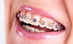 Smile with traditional braces