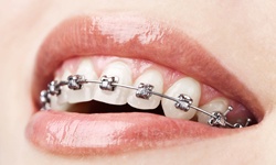 Smile with self-ligating braces