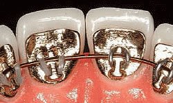 teeth with lingual braces