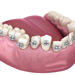 Illustration of crooked teeth with braces