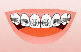 Animated smile showing proper way to brush with braces