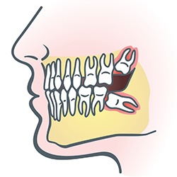 Animated smile with impacted wisdom teeth