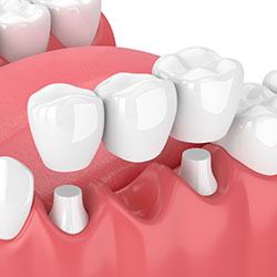 Animated smile during dental bridge placement