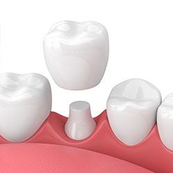 Animated smile during dental crown placement