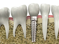 Animated smile with dental implant supported dental crown