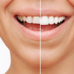 Wellesley cosmetic dentist holding a mirror up for a smiling paCloseup side-by-side comparison of a smile before and after veneerstient 