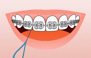 Animated smile showing proper way to floss with braces