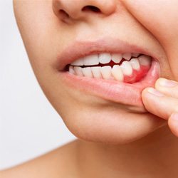 Closeup of patient pulling lip down to reveal red gums with gum disease