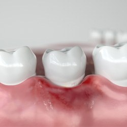 Digital closeup illustration of teeth surrounded by beginnings of gingivitis 