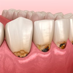 Closeup digital illustration of gum pockets caused by periodontitis 