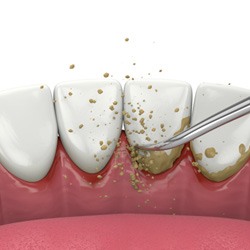 Digital illustration of tartar being cleaned away by scaling and root planing