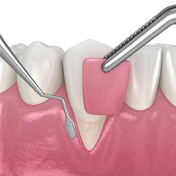 digital drawing of gum tissue being placed over tooth roots via soft tissue graft for gum disease