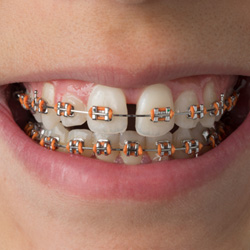 Close-up of person’s smile with gap between the front teeth and braces