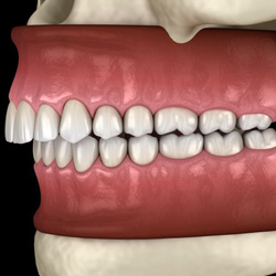 Illustration of an overbite against dark background