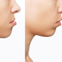 Side view of patient’s face before and after correcting an underbite