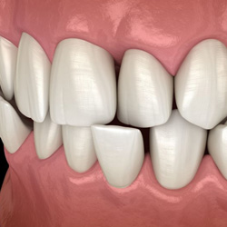 Illustration of a crossbite against dark background