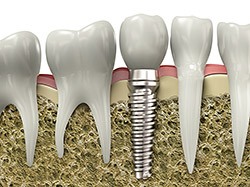 graphic of dental implant in jaw