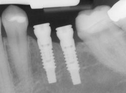 xray of dental implant in jaw