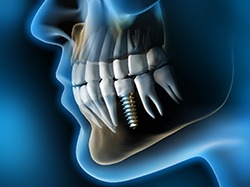 Digital X-ray illustration of dental implants in Wellesley 