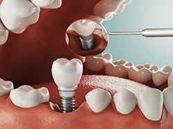 Computer monitor showing a 3D model of a patient’s jawbone before dental implants