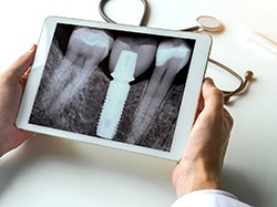 Digital illustration of a dental implant in Wellesley during placement 