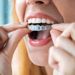 Woman placing Invisalign aligner on her teeth