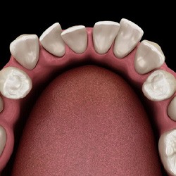 Illustration of crowded teeth viewed from above