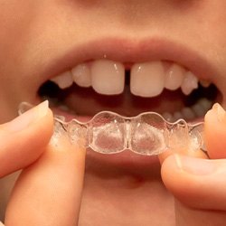 Close-up of person’s mouth as they prepare to wear clear aligner