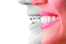 Smile with Invisalign compared to smile with traditional braces