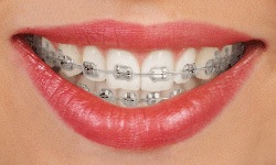 Smile with traditional braces