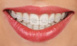 Smile with clear ceramic braces