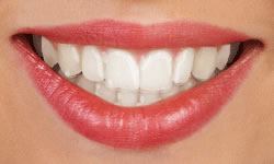 Smile with clear aligners