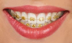 Smile with gold braces