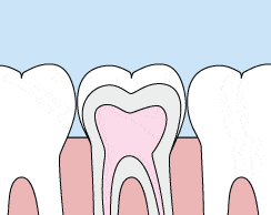 Animated smile showing sealant placement