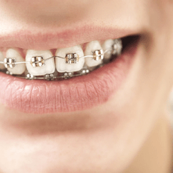 Close-up of smile with traditional metal braces in Wellesley