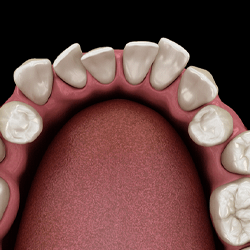 Illustration of crooked teeth, which can be fixed by braces